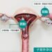 子宮外孕奪命風險高　東港安泰醫院成功搶救休克孕婦